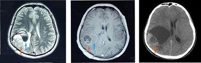 Rare Recurrent EWSR1-PLAGL1 Rearranged Intracranial Tumor With Biphasic Epithelioid Differentiation: One Case Report With Literature Review